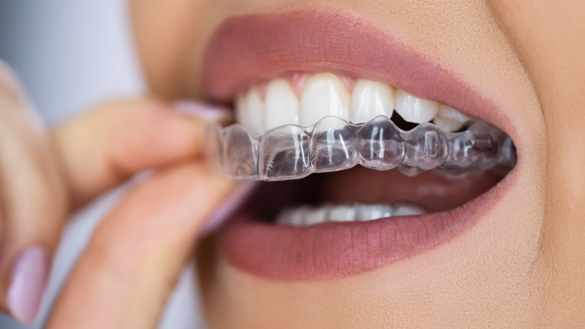 Placa de descarga transparente sobre molde dental